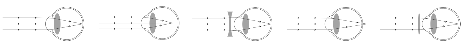 FIGURE - Optical Disorders